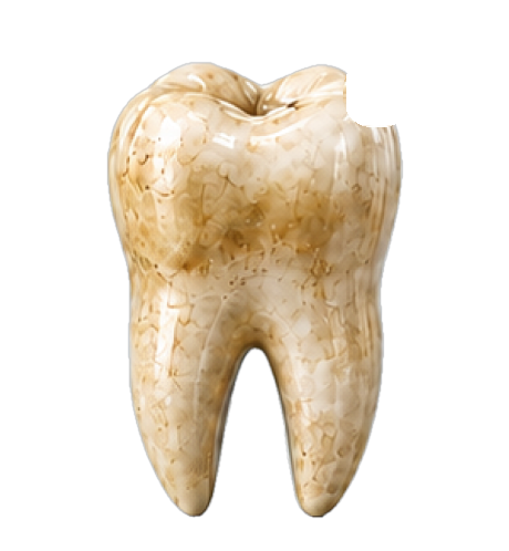 Tooth with surface stains